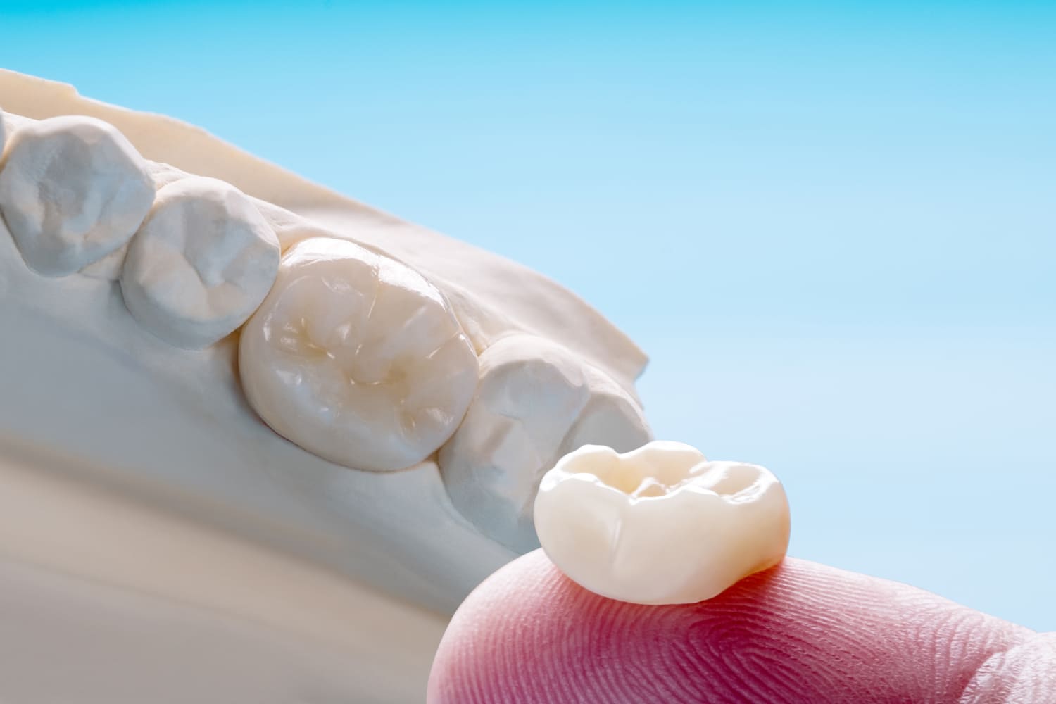 modelo-de-equipamento-de-coroa-e-ponte-de-dente-unico-restauracao-de-correcao-expressa