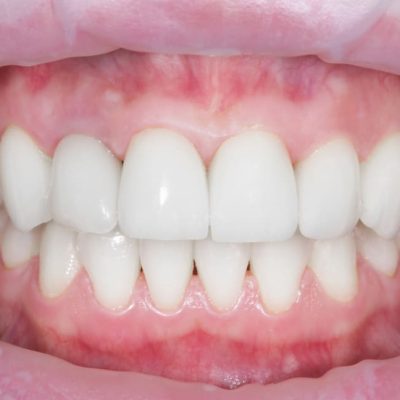 belo-sorriso-e-dentes-brancos-de-uma-jovem-implantes-ou-o-processo-de-clareamento-dos-dentes