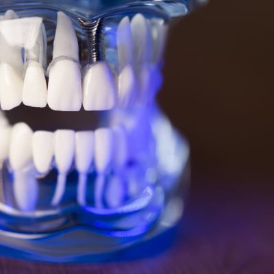 close-up-de-proteses-dentarias-na-mesa