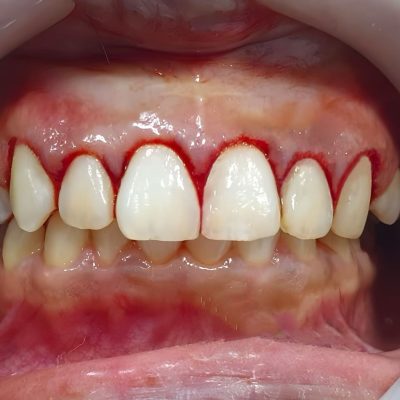 gengivoplastia