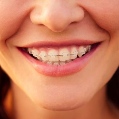 mulher-30-35-anos-de-idade-sorrindo-sorriso-dentuco-com-aparelho-no-fundo-mar-oceano-praia
